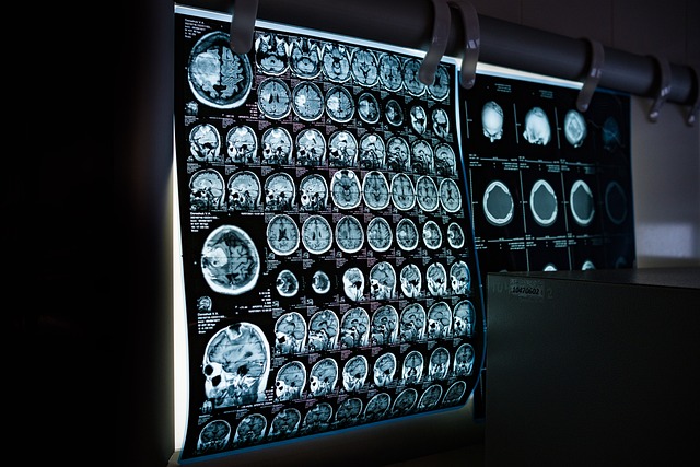 mesothelioma x ray